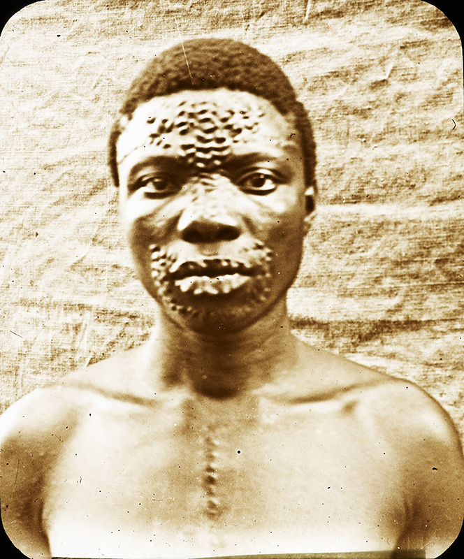 额头和嘴巴周围有许多疤痕的男人。 疤痕形成可识别的图案。