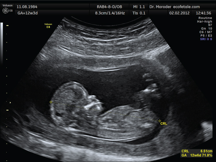Figura 1.1. Los futuros padres suelen utilizar ultrasonidos para hacerse una idea del sexo de su bebé antes de que nazca. Dr. Wolfgang Moroder; CC BY-SA.