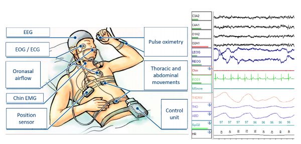 A sketch of a person lying down with recording electrodes for EEG, EOG, ECG, oronasal flow, chin EMG, position sensor, pulse oximetry, thoracic and abdominal movements. Data is show in traces with time on the x-axis and voltage on the y-axis.