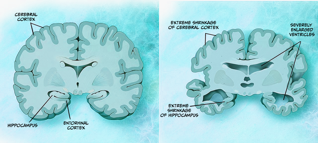 6.12-Alzheimers_disease_brain_comparison.png