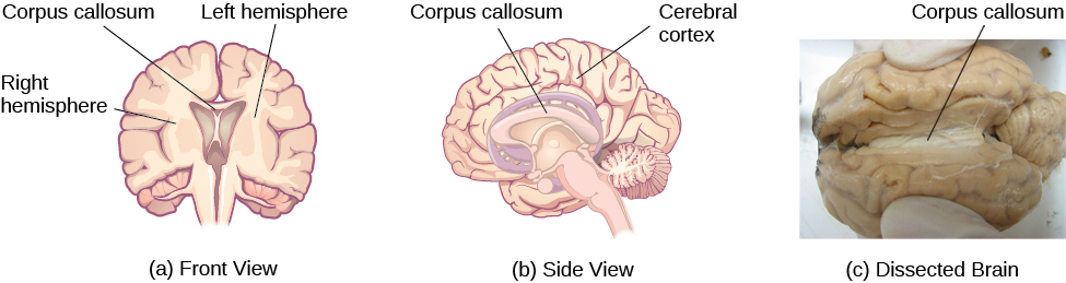 Les illustrations (a) et (b) montrent la position du corps calleux dans le cerveau, vues de face et de côté. La photographie (c) montre le corps calleux dans un cerveau disséqué.