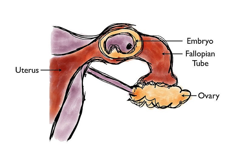 embryo developing in the fallopian tube in an ectopic pregnancy