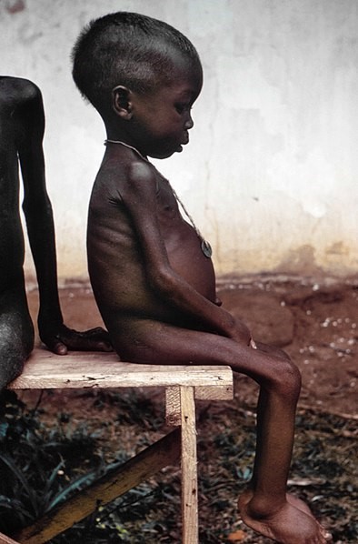 Very skinny child with bloated stomach sitting on a ledge with no clothes on