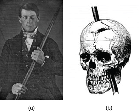 L'image (a) est une photographie de Phineas Gage tenant une barre métallique. L'image (b) est une illustration d'un crâne traversé par une tige métallique depuis la zone des joues jusqu'au sommet du crâne.