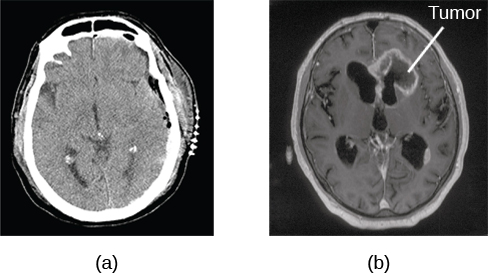 L'image (a) montre une scintigraphie cérébrale où l'apparence de la matière cérébrale est assez uniforme. L'image (b) montre une section du cerveau dont l'apparence est différente de celle des tissus environnants et qui est étiquetée « tumeur ».