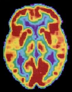 Une scintigraphie du cerveau montre différentes parties du cerveau de différentes couleurs.