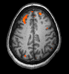 A brain scan shows brain tissue in gray with some small areas highlighted red.