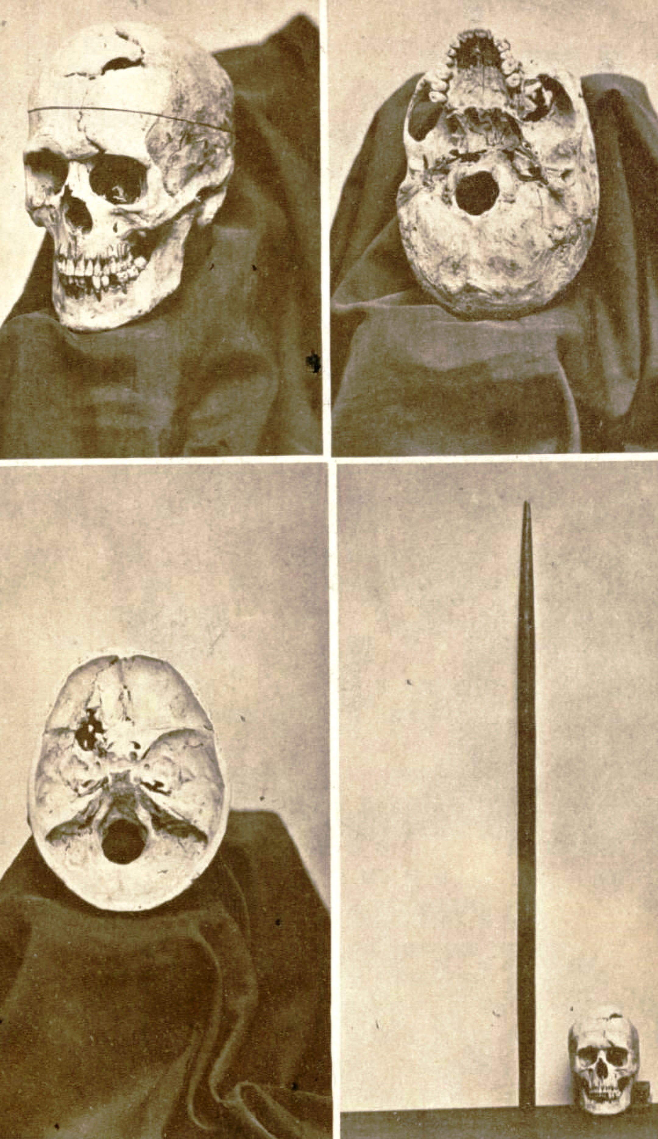Phineas Gage's skull and tamping iron