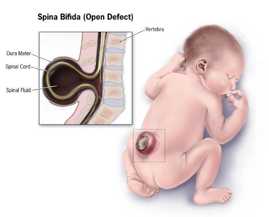 Infant with a bulging spinal cord above the lower spine.