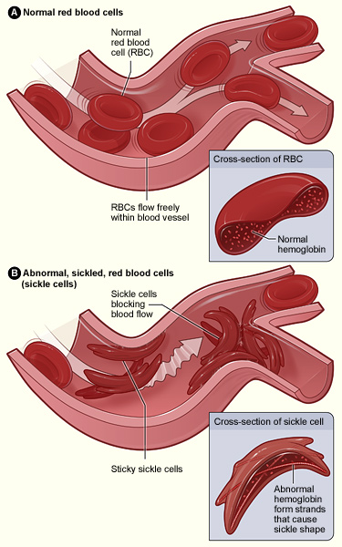 Normal (round) and sickle (crescent-shaped) red blood cells flow through a blood vessel.