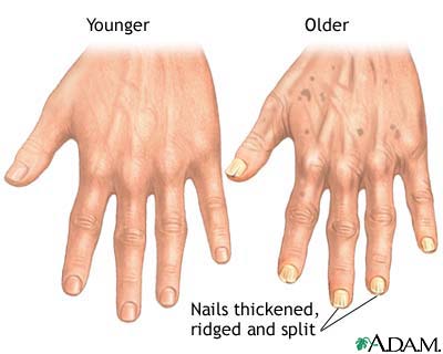 As people age, their nails thicken, become ridged, and split.