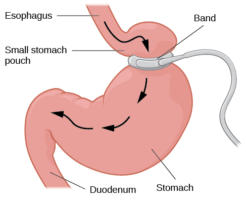 An illustration depicts a gastric band wrapped around the top portion of a stomach. A bulging area directly above the gastric band is labeled “Small stomach pouch.” The area directly below the stomach is labeled “Duodenum.” Down-facing arrows indicate the direction in which digested food travels from the esophagus at the top, down through the stomach, and into the duodenum.