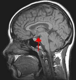 Brain scan image with the hypothalamus indicated by an arrow
