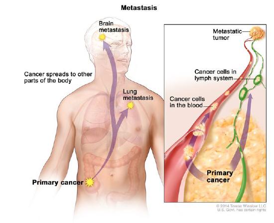 metastasis-enlarge.__v30070439.jpg
