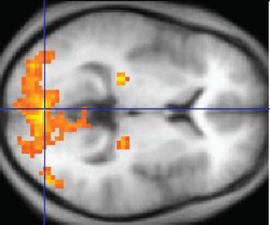 Esta imagen de MRI muestra una lectura granulada por computadora de una sección transversal del cerebro. El lado anterior del cerebro, ubicado en el lado derecho de la imagen, tiene una gran área iluminándose con amarillo, lo que indica estimulación neural. Dos regiones más pequeñas en el centro del cerebro también son amarillas. Las dos áreas pequeñas se encuentran en la misma ubicación relativa pero en hemisferios opuestos del cerebro.
