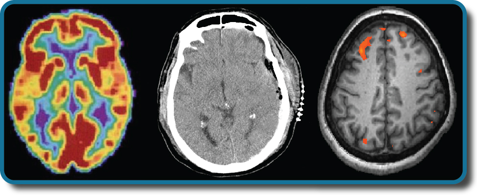 Three brain-imaging scans.