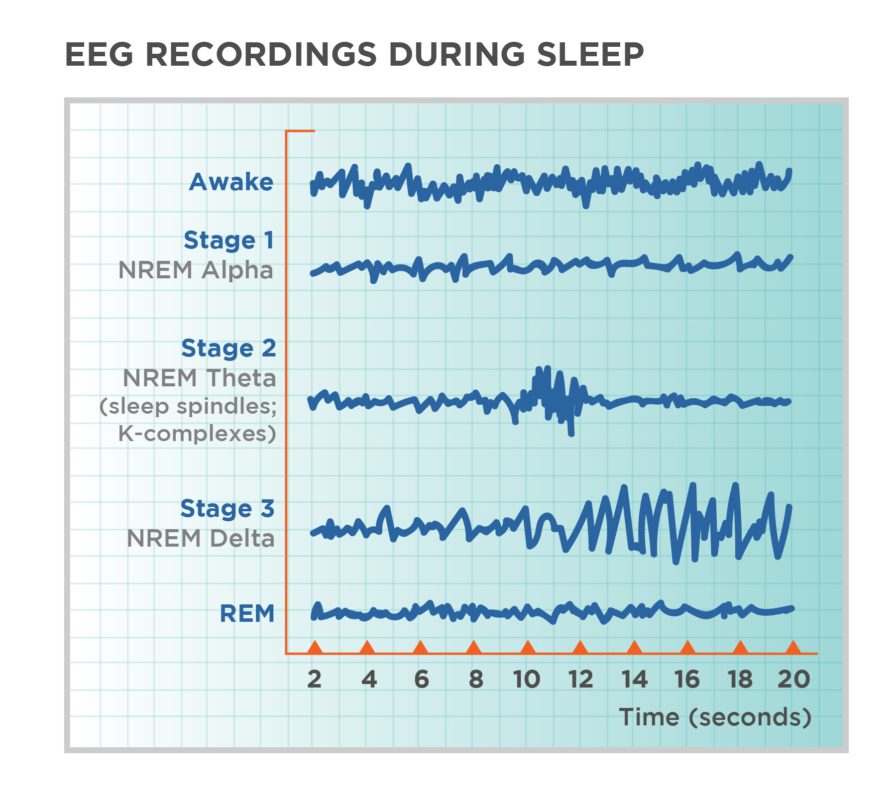 EEG Recordings During Sleep showing shape of brain waves at four different stages of sleep and, for comparison, brain waves while awake. Each sleep stage has associated wavelengths of varying amplitude and frequency. Relative to the others, “awake” has a very close wavelength and a medium amplitude. Stage 1 (NREM Alpha) is characterized by a generally uniform wavelength and a relatively low amplitude which doubles and quickly reverts to normal every 2 seconds. Stage 2 (NREM Theta (sleep spindles; k-complexes)) is comprised of a similar wavelength as stage 1 but lower amplitude. It introduces the K-complex from seconds 10 through 12 which is a short burst of doubled or tripled amplitude and decreased wavelength. Stage 3 (NREM Delta) shows a more uniform wave with gradually increasing amplitude. Finally, REM sleep looks much like stage 2 without the K-complex.