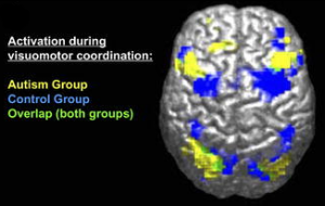 Imagen derivada de FMRI de diferencia entre cerebros de grupos autistas y control. La leyenda dice “Activación durante la coordinación visuomotora: Grupo de Autismo [amarillo], Grupo Control [Azul], Superposición (ambos grupos) [verde]”.