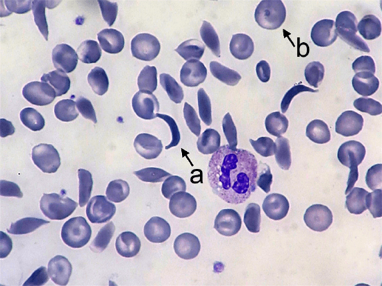 Sickle Cell Anemia. Arrows indicate (a) sickled and (b) normal red blood cells.