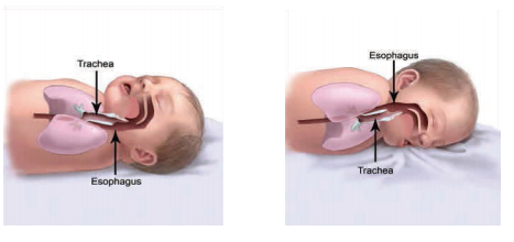 comparación de tráquea y esófogo de bebés que duermen boca arriba y boca abajo mostrando constricción de la traquea (vía aérea) cuando están boca abajo
