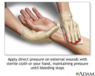 Detener el sangrado con presión directa