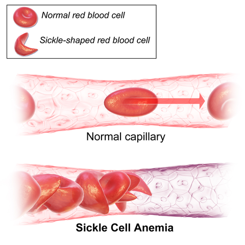 C:\Users\paris_j\Downloads\480px -Sickle_Cell_Anemia.png