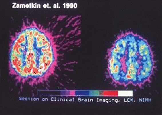 Brain scan of two brains, one with and one without ADHD showing significantly more activity in the brain with ADHD