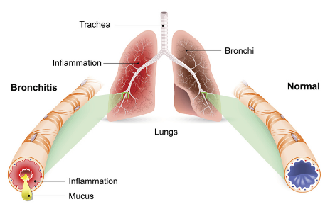 Gráfico que muestra un pulmón inflamado y vía aérea con Bronquitis junto a un pulmón y vía aérea sanos.
