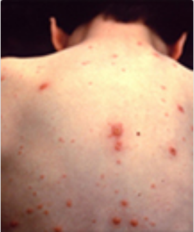 The back of a child showing their chickenpox marks