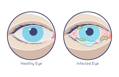 ojo sano y ojo infectado (rosa con secreción)