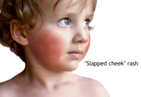 El rostro de un niño que tiene las mejillas muy rojas por sarpullido de “mejilla abofeteada”