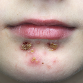 The mouth of a child with discoloration and blisters below the lips and on the chin