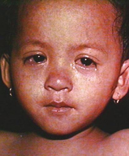 Ojos de un niño con sarampión.