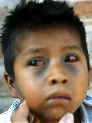 El rostro de un niño que tiene vasos sanguíneos rotos en los ojos y moretones oscuros que van desde las comisuras de los ojos hasta los pómulos