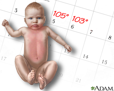 Un gráfico que muestra a un bebé con un calendario detrás. El calendario tiene temperaturas de 105 y 103 grados listadas en dos de los días. El bebé tiene una erupción que abarca la parte inferior de las mejillas y la barbilla hasta la parte inferior del estómago.