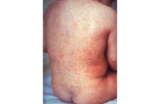Erupción de rubéola en la piel de la espalda del niño. La distribución es similar a la del sarampión, pero las lesiones son de color rojo menos intenso.