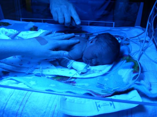 Premature infant born at 30 weeks, 4 days gestation to a mother with altitudinal-induced preeclampsia. Blue light assists the infant’s liver with processing high levels of bilirubin.
