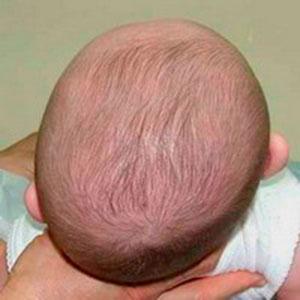 Infant with positional plagiocephaly. Notice the irregular shape of the posterior (back) of the skull.