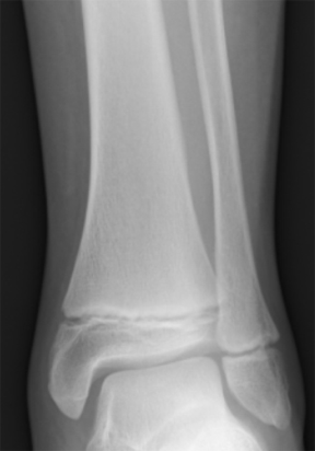 An x-ray of a subadult’s ankle with the epiphyses of the tibia and fibula visible. 