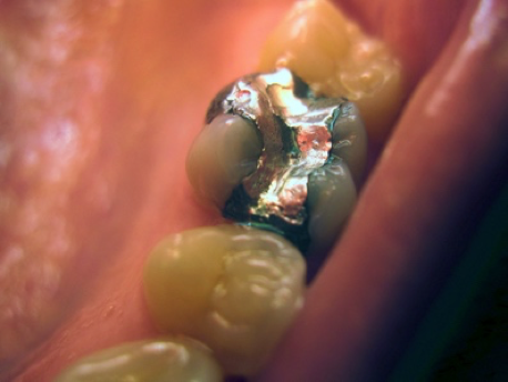 A human tooth with a filling.