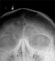 Xray of the unique shape of the frontal sinus.