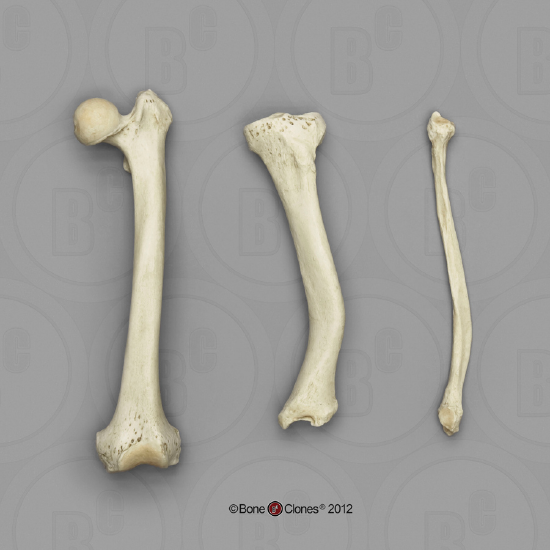 Example of rickets in long bones of the leg.
