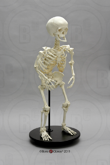 A cast of a complete skeleton of an adult female skeleton with achondroplasia.