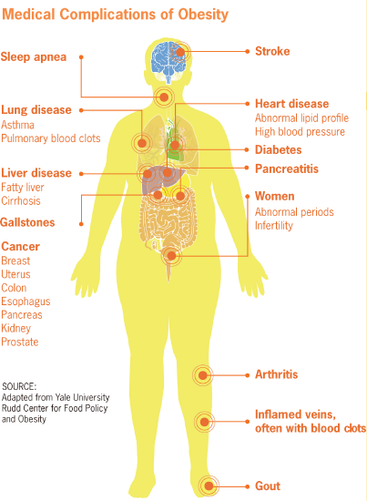Illustration of Medical Complications of Obesity.