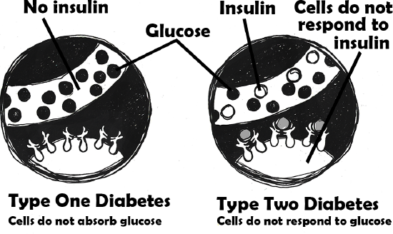 Illustration of Type 1 and Type 2 Diabetes.