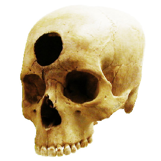 Un crâne est percé d'un grand trou dans le front.