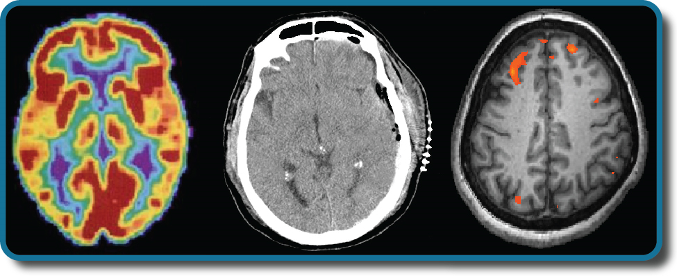 يتم عرض ثلاث عمليات مسح لتصوير الدماغ.