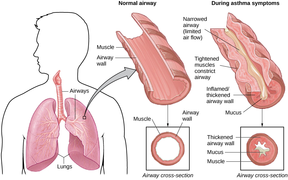Se ilustra el efecto del asma en las vías respiratorias. Se muestra una silueta de una persona con los pulmones y las vías respiratorias etiquetados. Hay una flecha proveniente de una vía aérea en el pulmón que conduce a una ampliación de una vía aérea normal. Una sección transversal de la vía aérea normal muestra el músculo y la pared de la vía aérea, con mucho espacio para que pase el aire. También se muestra una vía aérea durante los síntomas del asma, y los síntomas etiquetados son la vía aérea estrechada (flujo de aire limitado), los músculos tensos estrechan las vías respiratorias, la pared inflamada/engrosada de las vías respiratorias y la mucosidad. Una sección transversal de la vía aérea durante los síntomas del asma muestra la pared de la vía aérea engrosada, moco y músculo. Hay mucho menos espacio para que pase el aire.