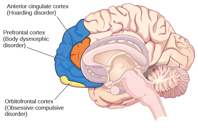 大脑的插图确定了三个区域及其相关疾病的位置：前扣带皮层（囤积障碍）、前额叶皮层（身体变形障碍）和眶额叶皮层（强迫症）。