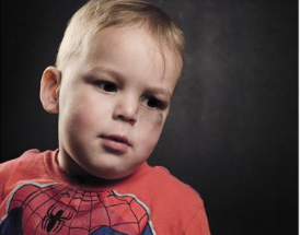 A photo of a young boy with a bruise on his face